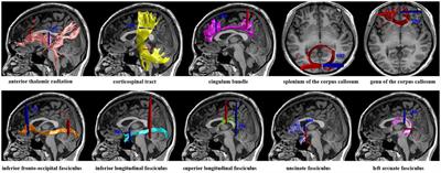 Microstructure abnormalities of the diffusion quantities in children with attention-deficit/hyperactivity disorder: an AFQ and TBSS study